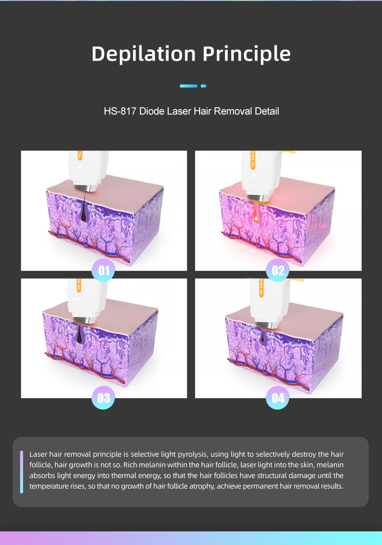 3 wavelength diode laser hair removal device HS-817插图4