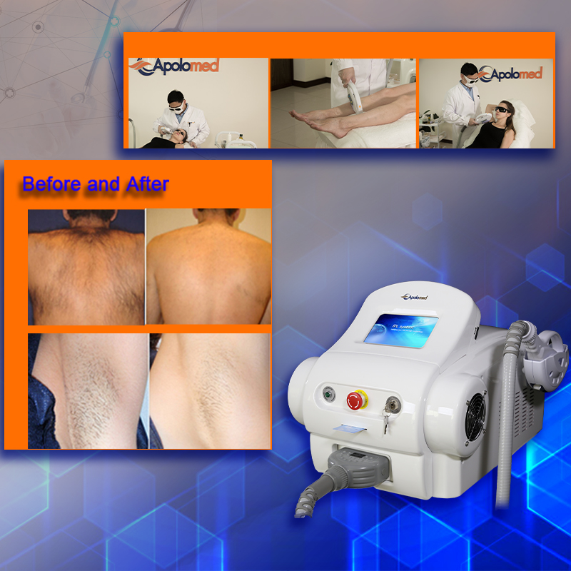 IPL hair removal HS-300A插图1