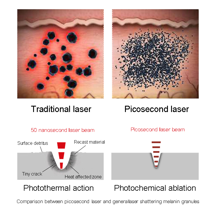 What is a Picosecond Laser?插图