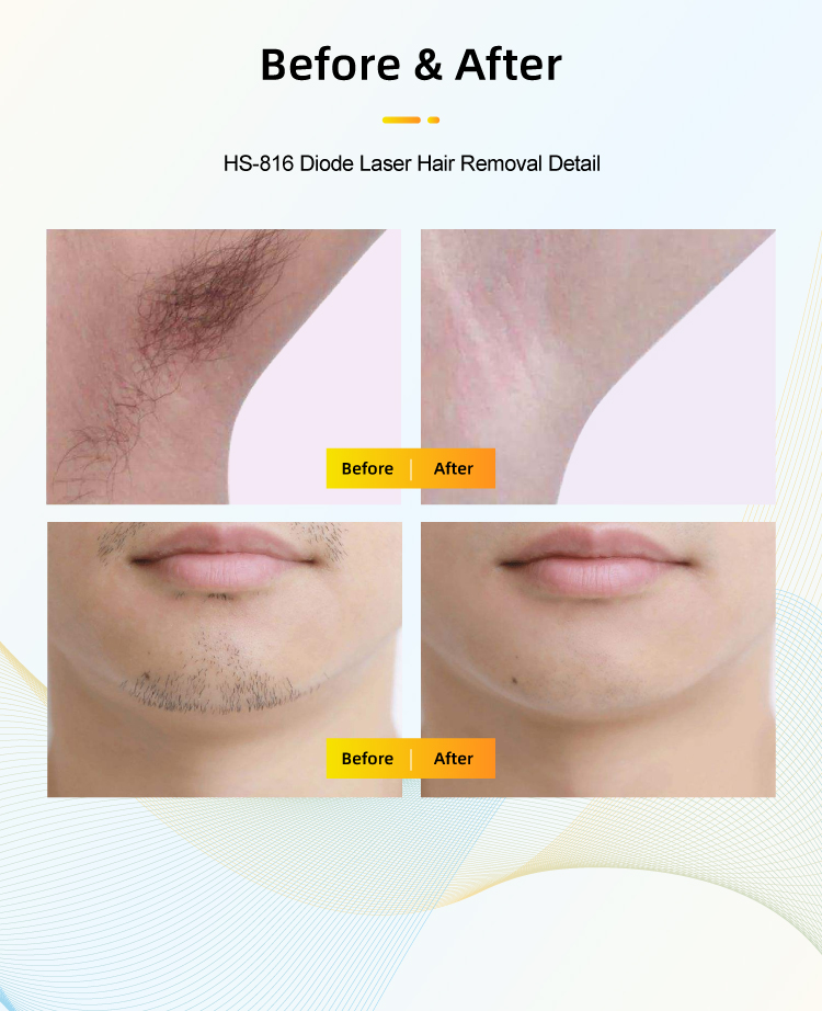 apolomed diode laser hair removal machine HS-816插图5