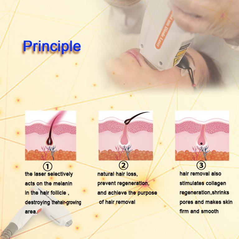 diode laser hair removal HS-812